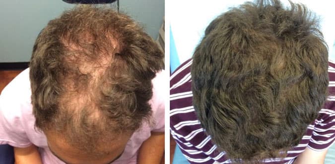 Before and after photo of man showing hair growth after using topical finasteride